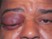 The man in the photo below presents to the ER with severe pain in the right eye that began the same morning.  His CT scan is also seen below.  He has no previous history of trauma.  Which of the following is not true of the situation?