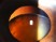 A patient with phacodonesis and cataract as shown in the photo desires surgery.  Which option is the safest method in this situation?
