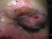 The patient depicted in the photo was scheduled for a surgical procedure which was aborted at the beginning of the case.  The photo was taken 2 weeks after the scheduled surgery.  What was the most likely intraoperative event?