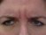 The patient in the picture received an injection of Botox.  Which muscles were targeted?