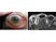 The photo seen below is of a patient presenting with proptosis, pain and increased intraocular pressure on the left.  A corresponding MRI is below.  What is the most likely diagnosis? 