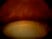 Ectopia lentis in a patient with Marfan’s syndrome is characteristically in which direction:	