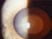 Which is not a type of congenital cataract?