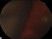 Which of the following is NOT a risk factor for suprachoroidal hemorrhage? 