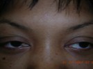 A 40 y.o. female pictured below comes to the office with swelling of both upper lids, mild shortness of breath and symptoms of dry eyes.  One would expect to see as part of her work up: