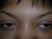 A 40 y.o. female pictured below comes to the office with swelling of both upper lids, mild shortness of breath and symptoms of dry eyes.  One would expect to see as part of her work up: