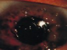 The patient depicted in the photograph below would be best treated with: