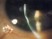 The following is a slit lamp photograph of a 60 year old woman with complaints of chronic foreign body sensation. Which of the following is the least likely cause of her condition? 
