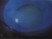 The following is a photograph after fluorescein staining of a 40 year old patient with complaints of gritty sensation OU for the past several months. All of the following might be expected except: