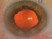 The Malyugin ring is least helpful in which of the following cases:
