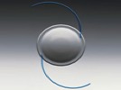 Which of the following is not a potential complication after cataract surgery with implantation of a multifocal IOL:
