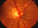 The disorder shown is associated with: