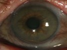 The most likely cause of the pigmentation depicted in this image is: