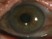 The most likely cause of the pigmentation depicted in this image is: