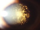 The vitreous particles of asteroid hyalosis are composed of: