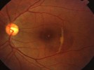 A patient with the fundus lesion shown is at risk for developing:	