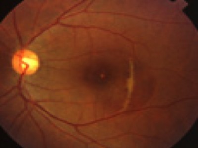 the fundus