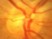 A Hollenhorst plaque is composed of: