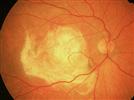 New Treatments for AMD