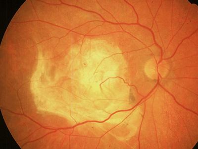 New Treatments for AMD