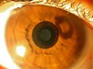 Presbyopia Treatment