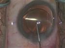 Toric IOL Rotator