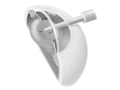 Pearls for the Preoperative Evaluation and Postoperative Management of Cataract and Lens Implant Surgery Patients