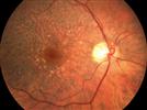 Glaucoma: Comparison of Optic Nerve Imaging Technologies