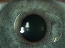 Phakic Intraocular Lenses: A review