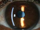 Pearls for the Preoperative Evaluation and Postoperative Management of the Ocular Surface in Cataract Surgery Patients