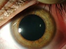 Treating blepharitis to stabilize the tear film and improve visual function after cataract surgery
