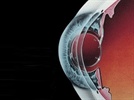 2011 Intraocular Lenses in Review