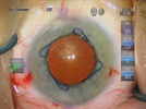 Pearls for Cataract Surgery in Patients With Small Pupils