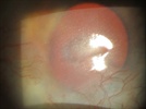 Surgical Pearls & Technique:  Anterior Segment Ophthalmic Surgery