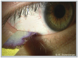 Schirmer’s test