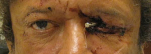 External photograph of the patient after injury to the left upper eyelid and orbital prosthesis with a TASER dart