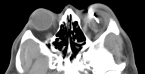 Axial CT scan showing the tip of the TASER barb in the orbital implant