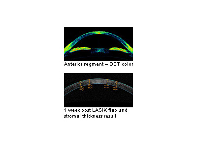 Anterior Segment Imaging, New LASIK Information