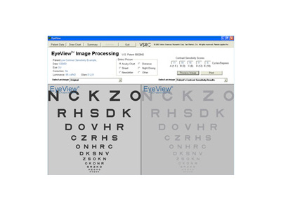 Demonstrates that the low normal vision patient may still refract to best-corrected 20/30 with overall reduction in contrast sensitivity in all five frequencies.