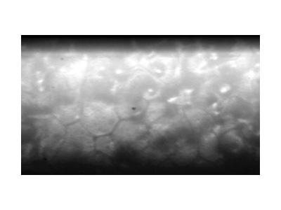 Image Sample: Abnormal Cells