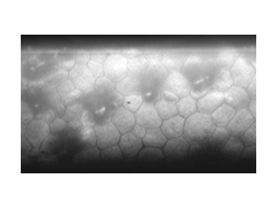 Image Sample: Abnormal Cells