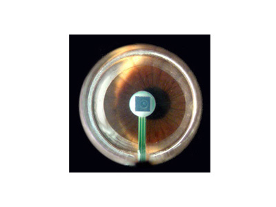 Contact area of cornea as seen through slit lamp