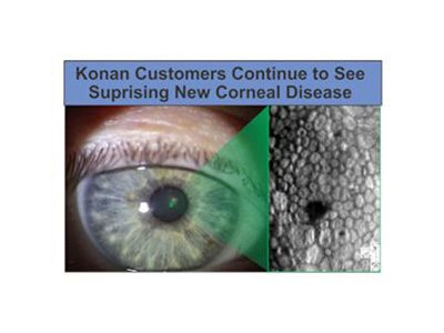 Surprising pathology missed with standard biomicroscopy.