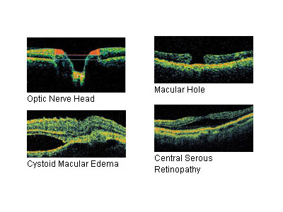 Optic Nerve Analysis
