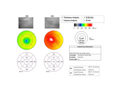 Macula Analysis