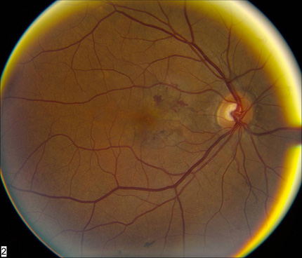 Time Domain Versus Spectral OCT In The Diagnosis And Treatment Of Angioid Streaks Time Domain Versus Spectral OCT In The Diagnosis And Treatment Of Angioid Streaks