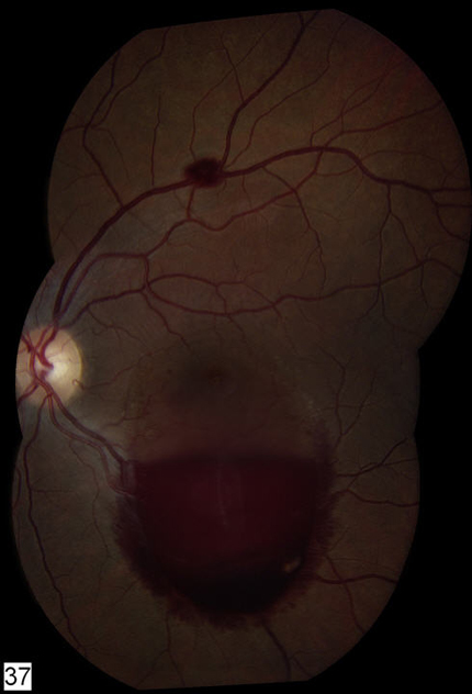 Our Patient Was Managed With Observation He Experienced Improvement Of His Vision From HM To 20 50 OS At The 3 Month Follow Up Visit Our Patient Was Managed With Observation He Experienced Improvement Of His Vision From HM To 20 50 OS At The 3 Month Follow Up Visit