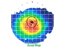 Case Report Changing Vision After Lasik Ophthalmologyweb Case Report Changing Vision After Lasik Ophthalmologyweb
