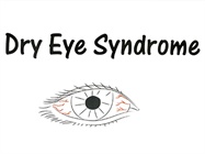 Dry Eye Syndrome - OCULUS, Inc.