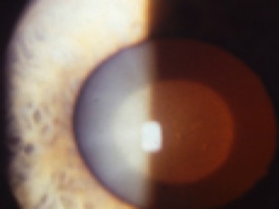 Which is not a type of congenital cataract?